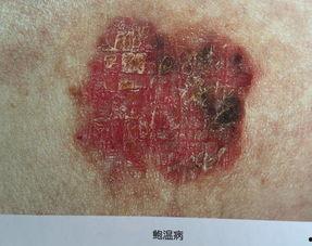 鲍温样丘疹图片,揭秘皮肤病变的早期信号