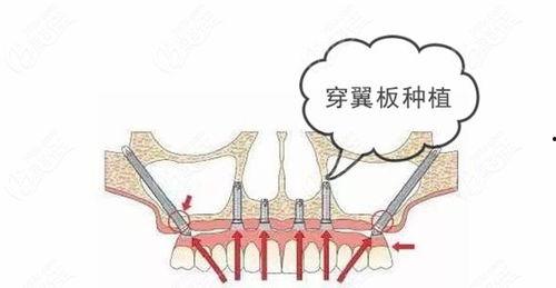 种植牙流程视频,从术前评估到术后护理的全方位流程解析