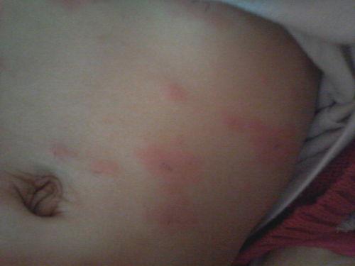 女性湿疹图片,揭秘湿疹图片背后的肌肤之谜